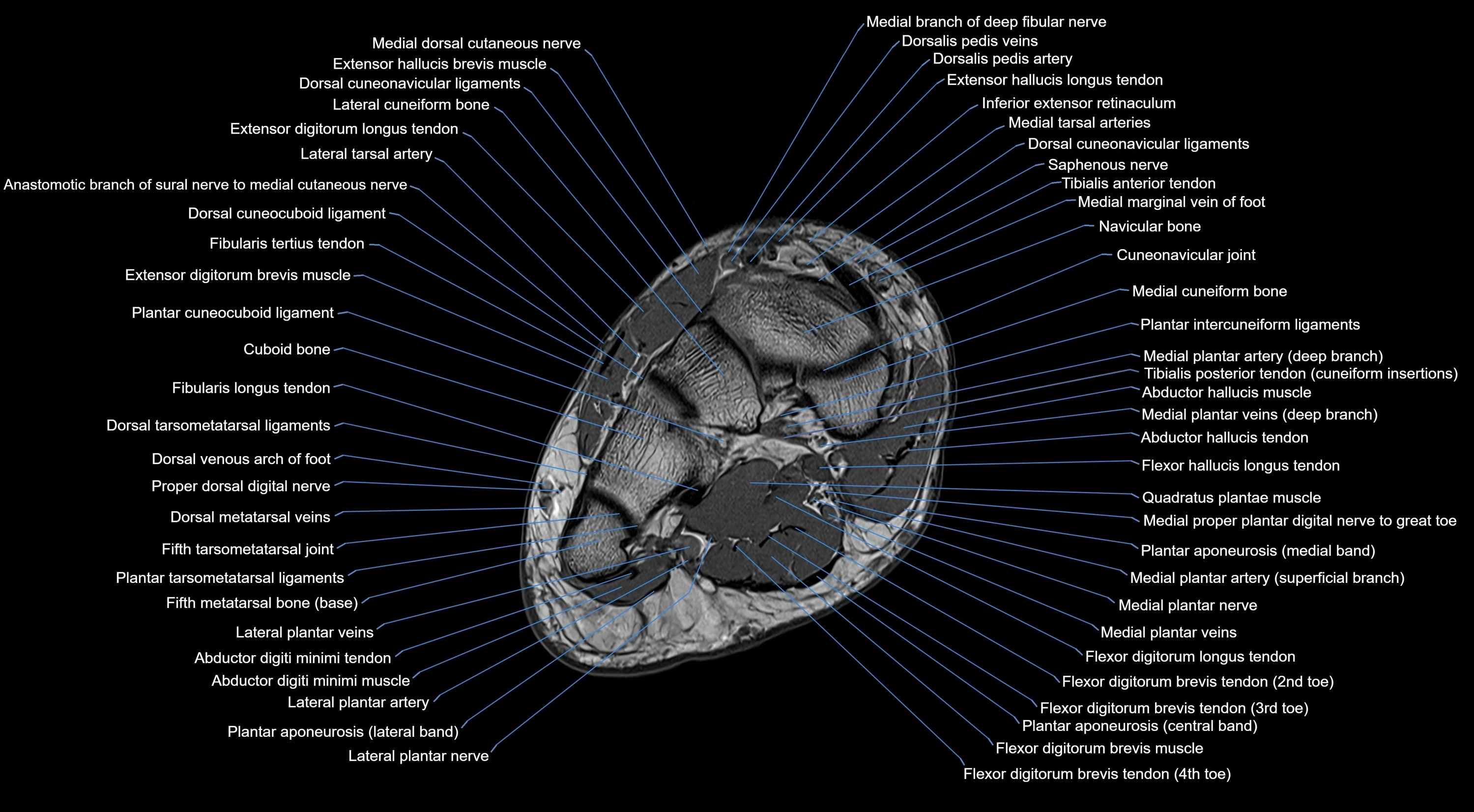 MRI mid foot coronal ligaments cross sectional anatomy 3T  radiology  image-img-00001-00025.webp
